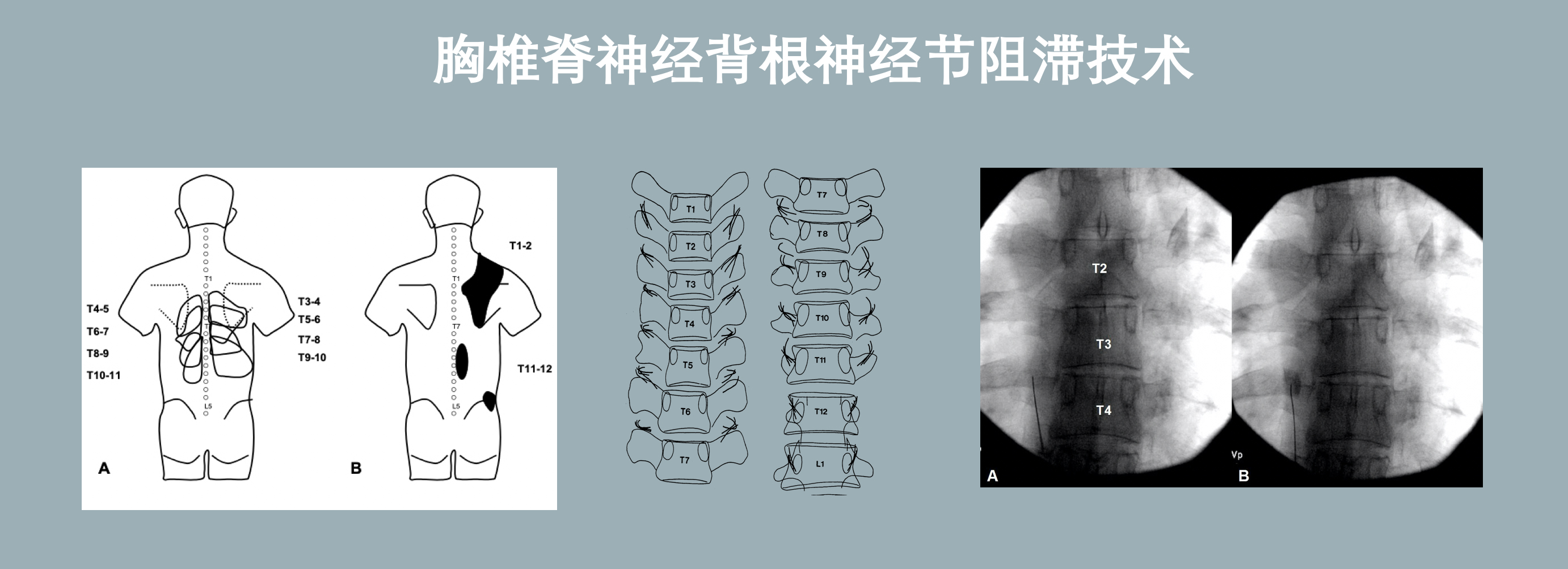 胸椎小关节综合征