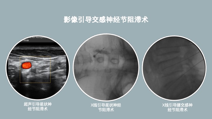 影像引导交感神经阻滞术