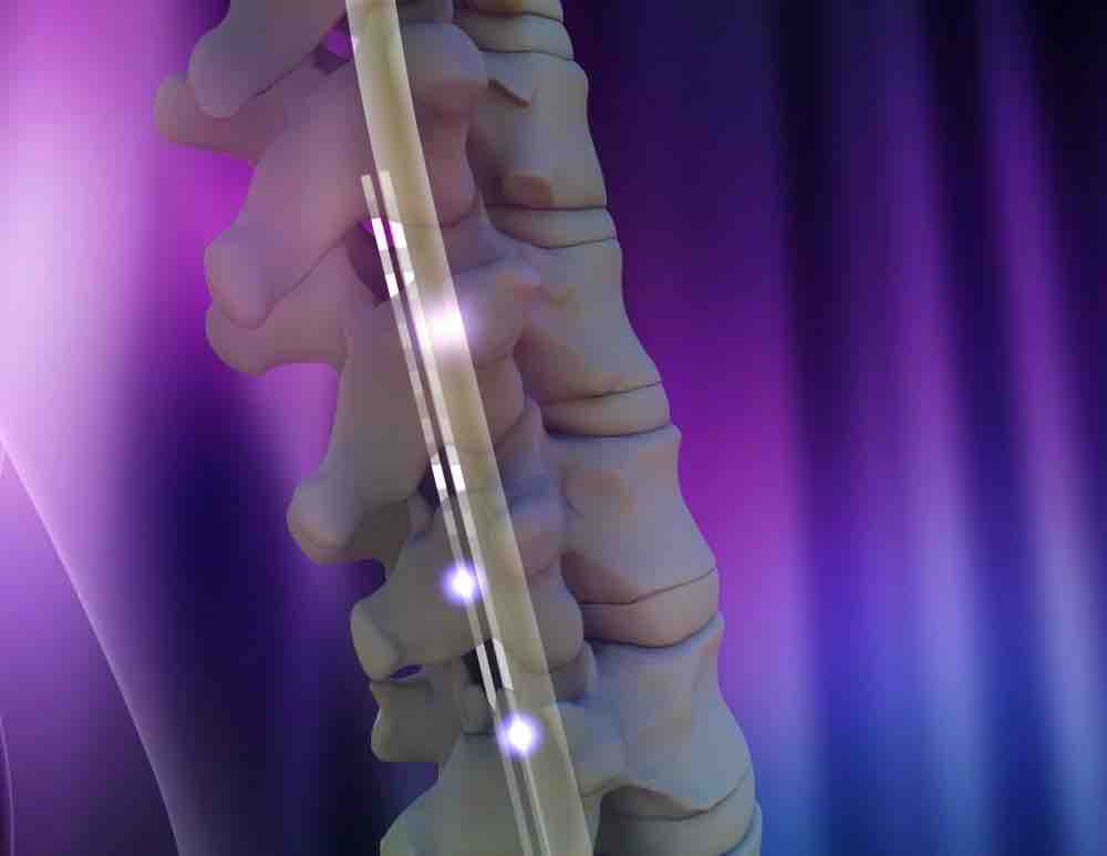 美国FDA对实施脊髓刺激器置入治疗的最新建议